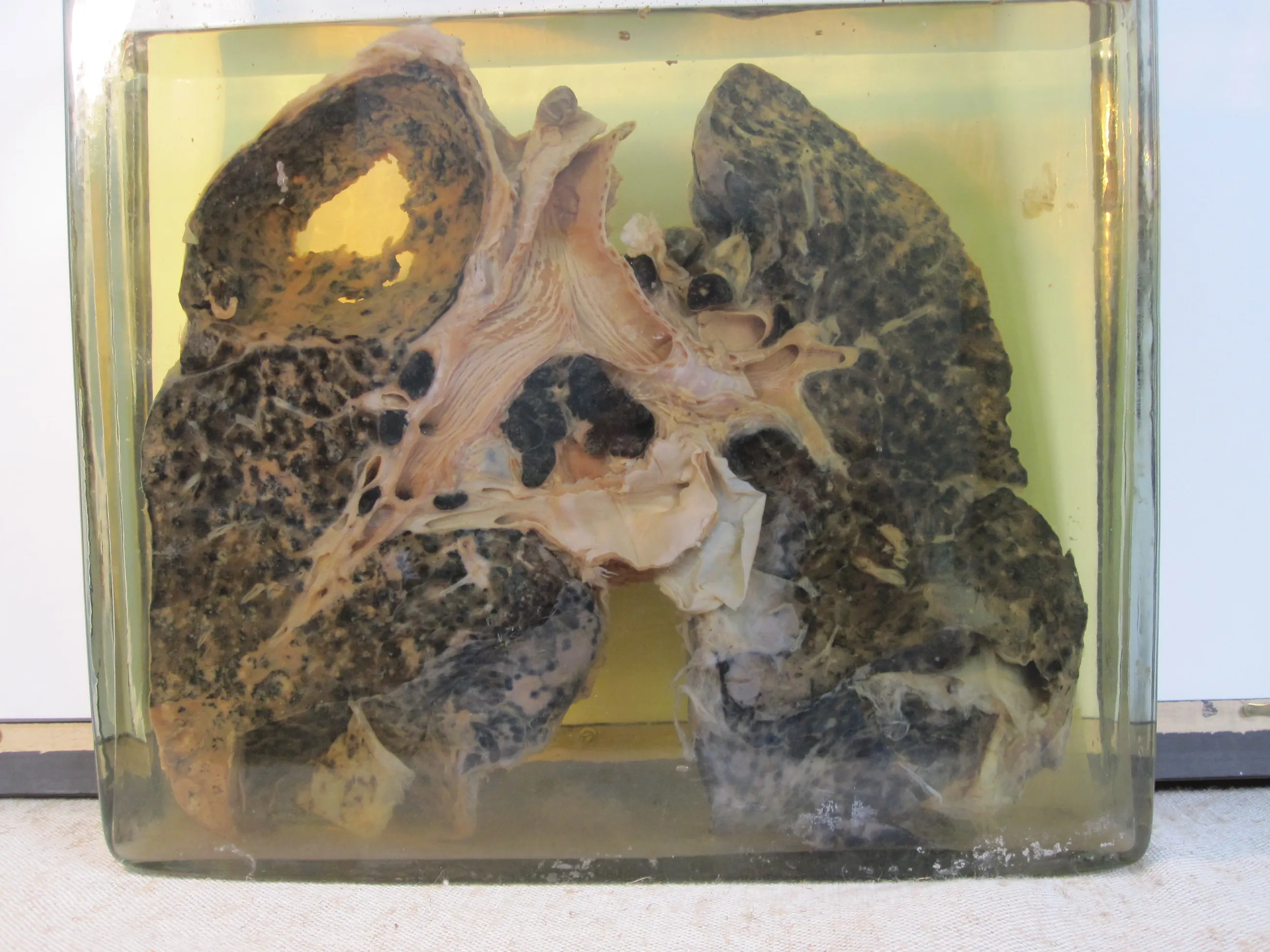 Geconserveerde menselijke longen met schade door silicose en tuberculose, tentoongesteld in een glazen houder met gelerige conserveringsvloeistof