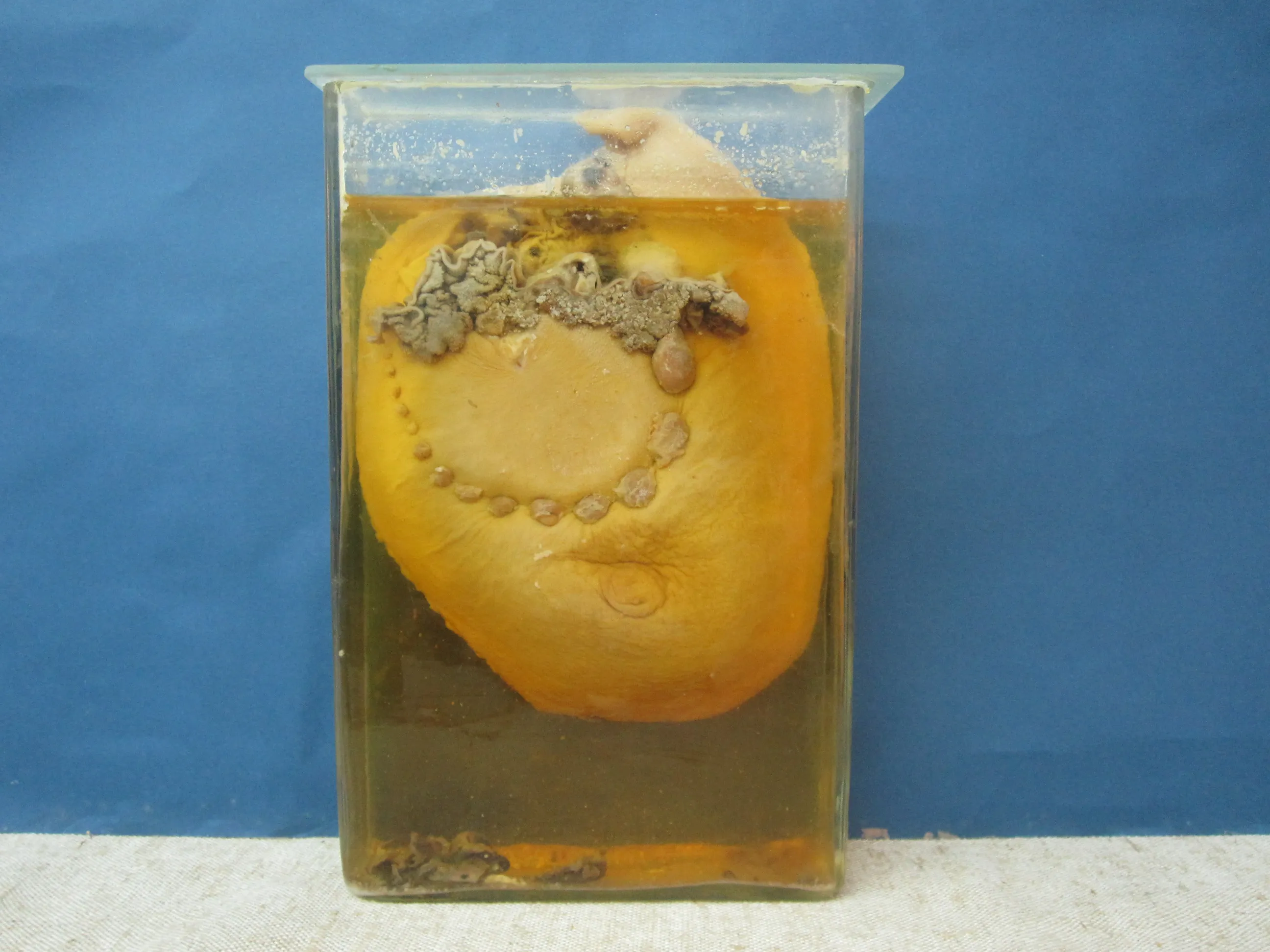 Preserved breast tissue specimen with visible tumor mass in a rectangular glass jar filled with amber liquid against a blue background